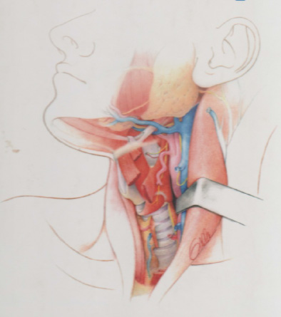 dessin chirurgie des lésions cervicales