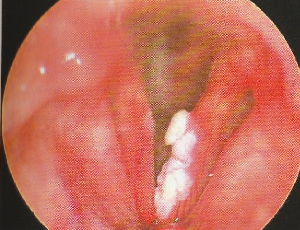 leucoplasie des cordes vocales